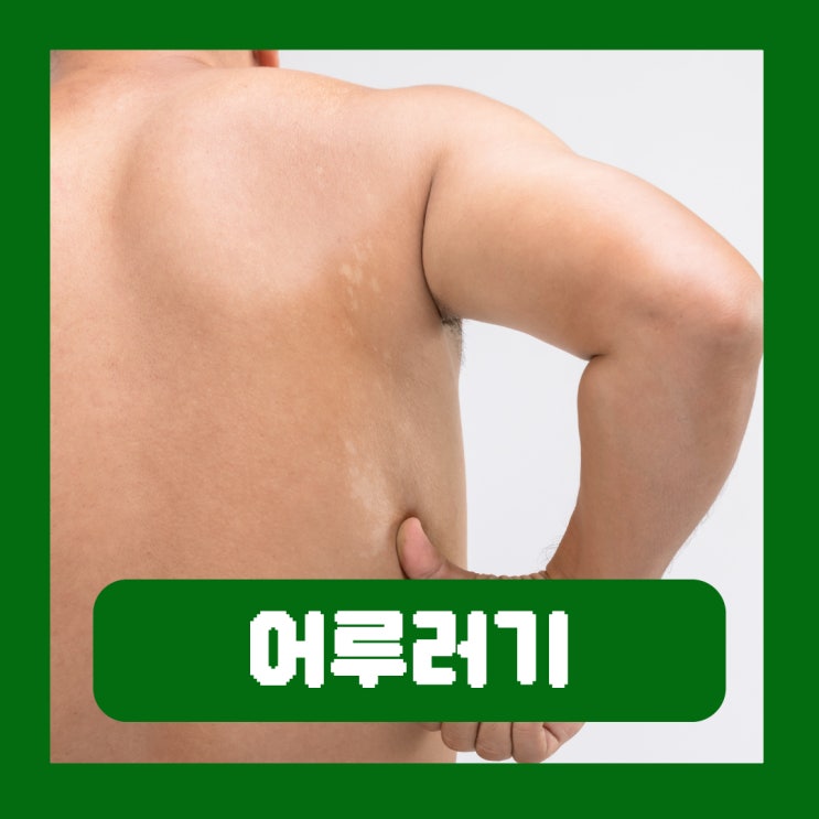  피부 어루러기 연고 곰팡이균 원인 증상 치료