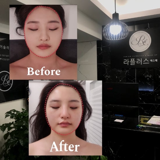 대구남구피부관리샵 대명동 「 라플러스에스떼 」 작은얼굴윤곽케어 솔직후기 대구남구피부관리샵 대명동 「 라플러스에스떼 」 작은얼굴윤곽케어 솔직후기