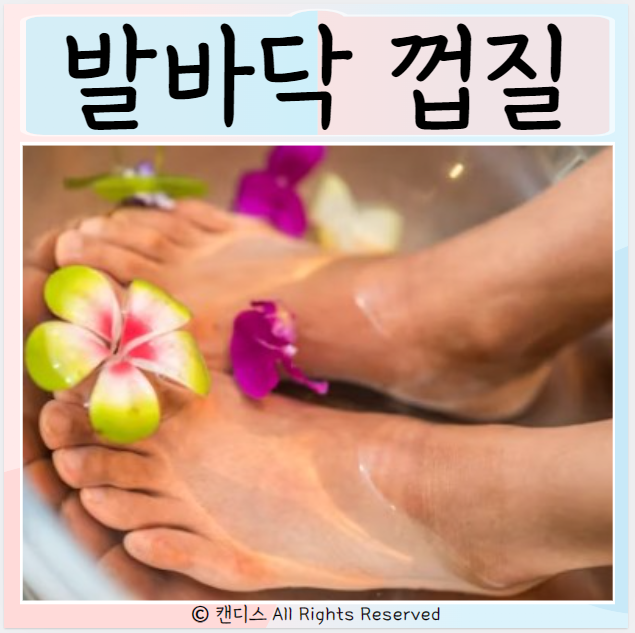  발바닥 껍질 벗겨지는 이유는? 박탈성각질융해증 관리