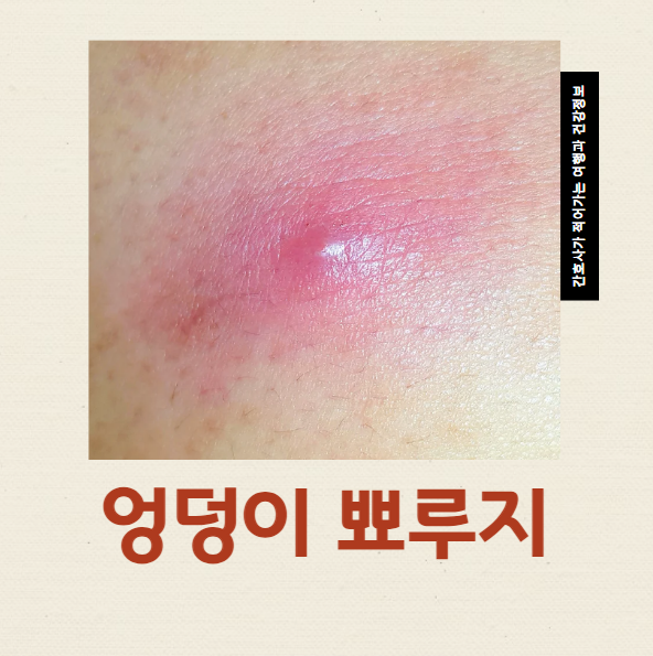  엉덩이 뾰루지 원인 없애는법 집에서 관리하기