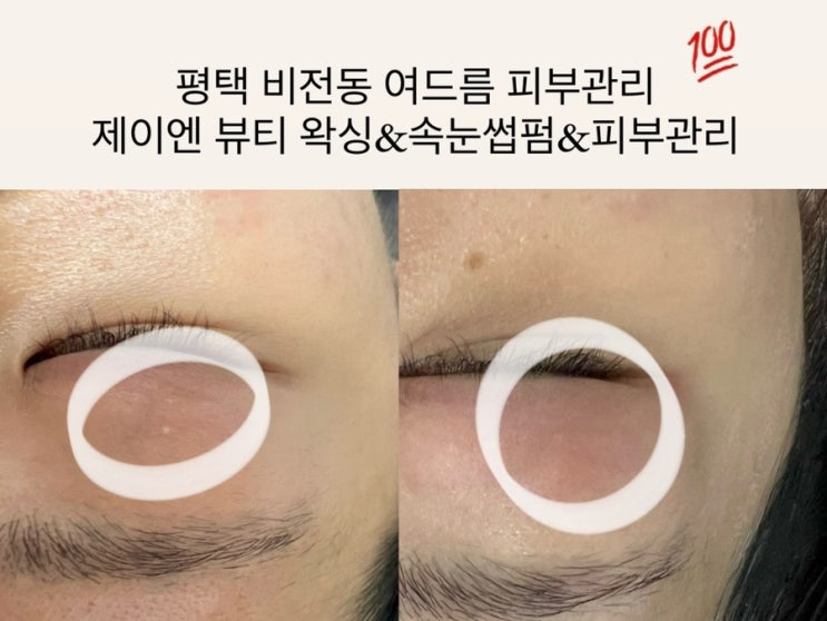  평택 비전동 피부관리 제이앤뷰티 지성피부 트러블 고민 해결