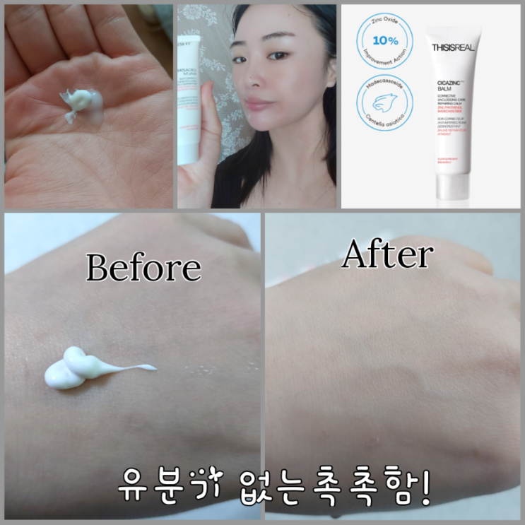  시카고민케어 민감한 피부를 위한 저자극 안심 여드름 흉터관리엔 디시즈리얼 시카징크 밤 크림 여드름 흉터케어