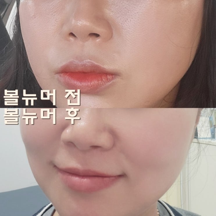  김해 내외동피부과 볼뉴머 300샷 리프팅 솔직후기