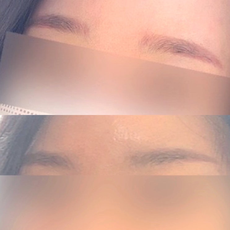  눈썹 붉은 잔흔 제거 레이저 1년 뒤 경과 전후 사진