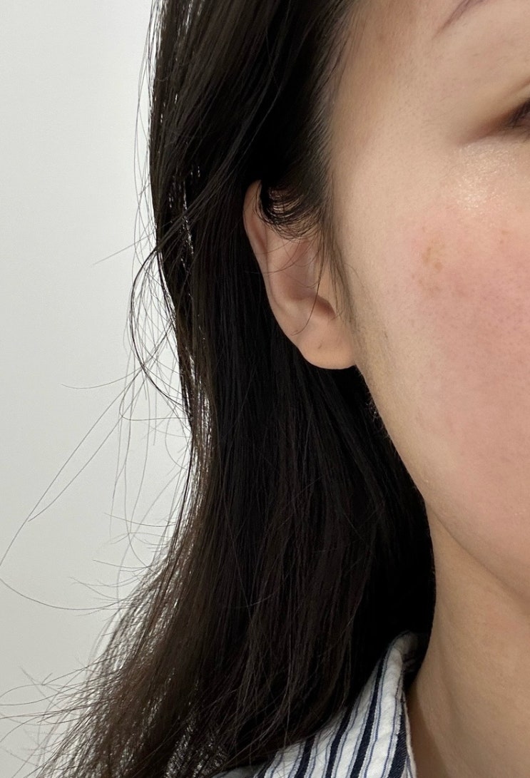  하남 미사 피부과ㅣ듀얼토닝 4회차 솔직후기 : 내돈내산ㅣ기미 잡티 레이저토닝 제네시스