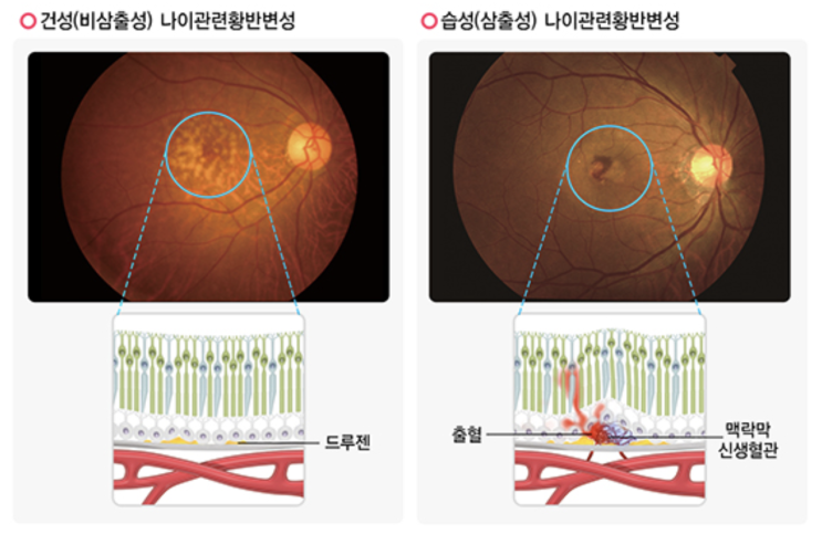 멜라토닌 고령에 의한 황반변성 예방, 멜라토닌의 효능은? 멜라토닌 고령에 의한 황반변성 예방, 멜라토닌의 효능은?