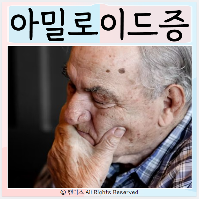  아밀로이드증 증상 치료 치매 원인 진단