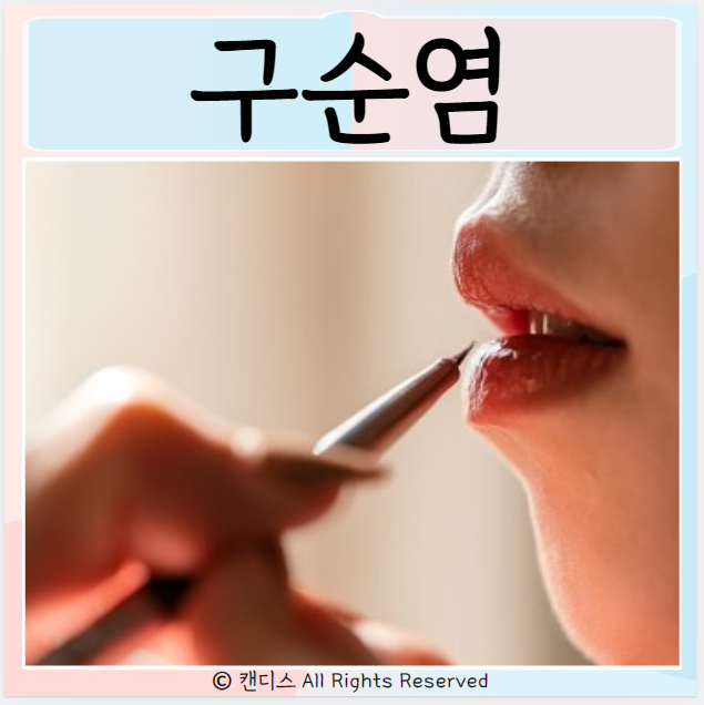  구순염 종류 원인 박탈성 광선 선구각 구순염 종류 관리