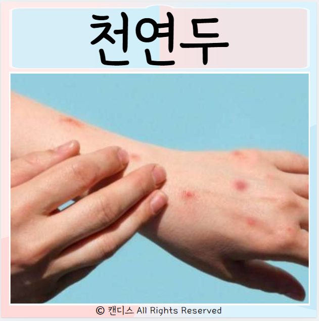  천연두 원인 전염 증상 백신 치료