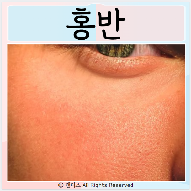  홍반 종류 감염성 다형홍반 홍반루푸스 치료
