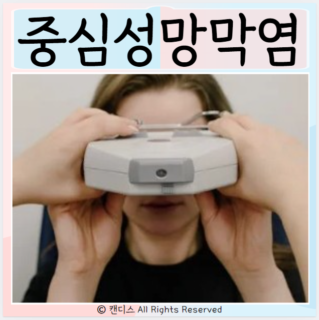  중심성망막염 진단 치료 원인 증상
