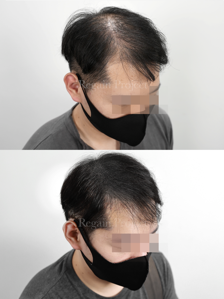 강남 smp두피문신으로 탈모 고민을 해결하고 싶다면?이것만 기억하세요