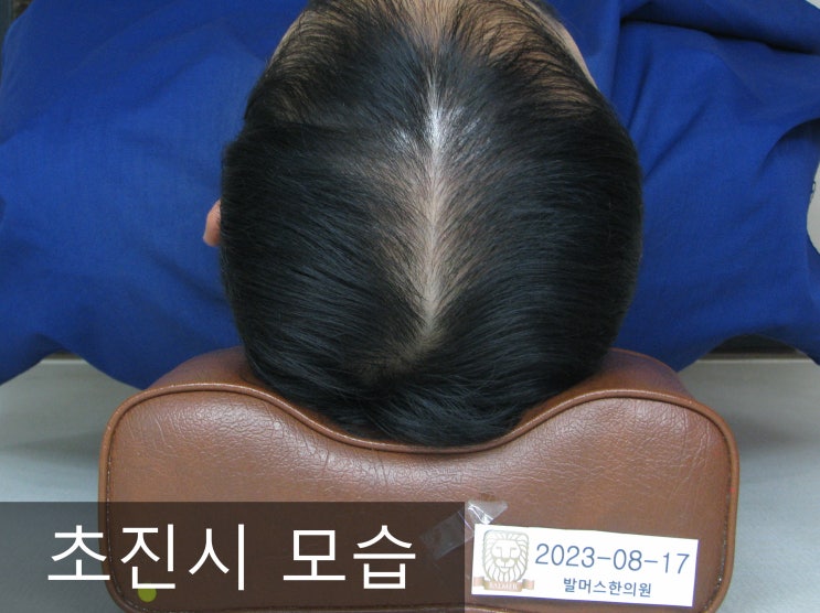  홍대 탈모치료, 남자 앞머리부터 정수리까지 가르마 탈모의 사례