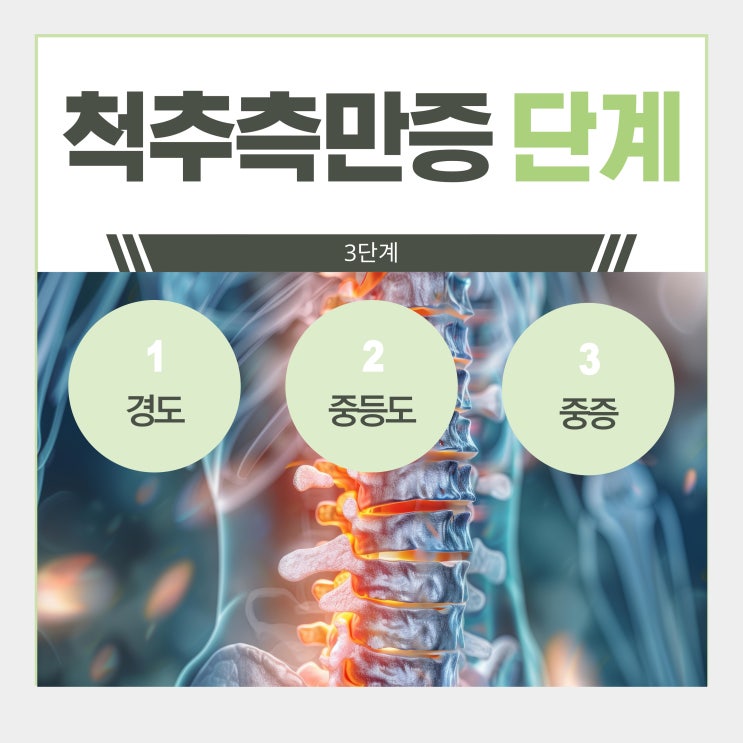  수원 어린이 척추측만증 병원, 단계별 치료는 이렇게