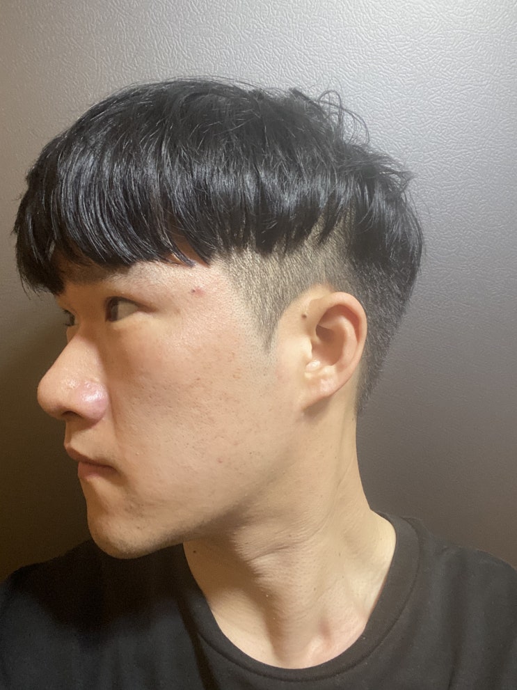 [이오코 크림 바르기 전후] 여드름적합크림 성인 여드름 고민이라면 유황크림으로