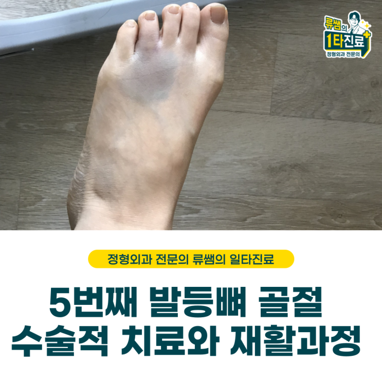  넘어지면서 발생한 5번째 발등뼈 골절의 수술적 치료 (의사작성)