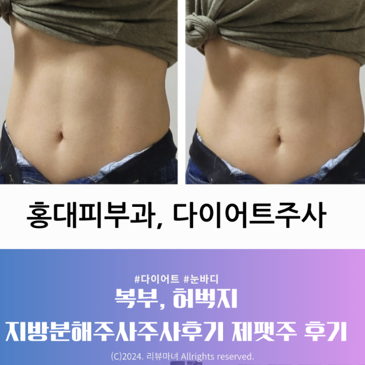  홍대피부과 다이어트주사 복부 허벅지_제팻주 3회 후기