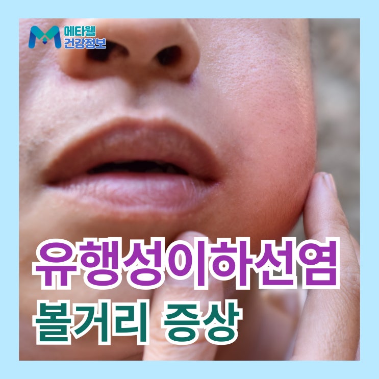  볼거리 증상 치료 전염 여부, 유행성 이하선염 격리 해야하나요?