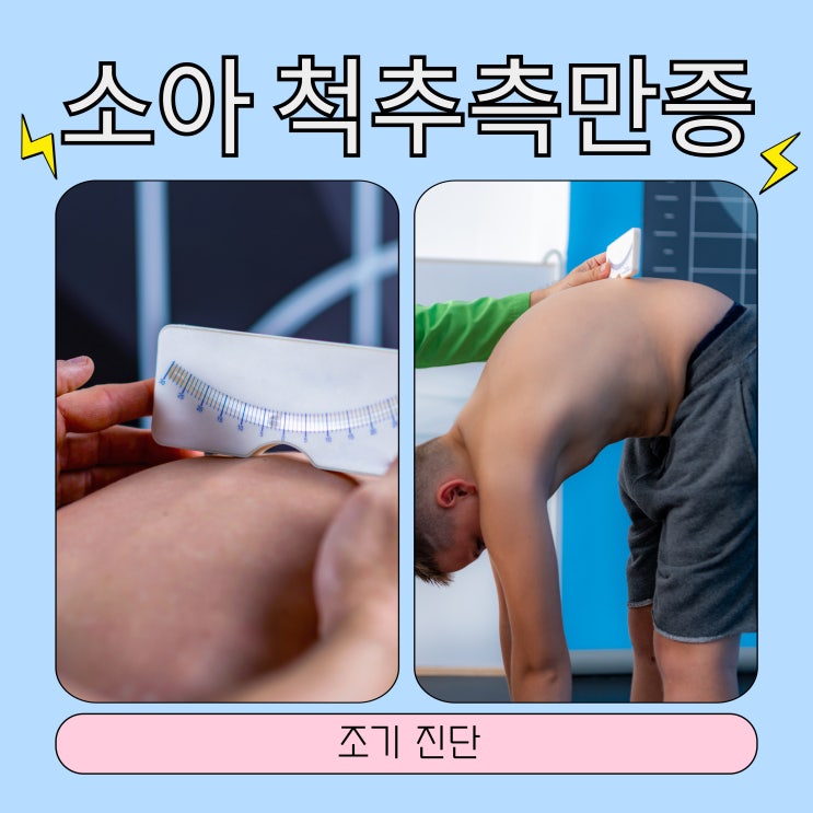  수원 소아 척추측만증 증상 조기 진단하는 방법 꼭 확인하세요.