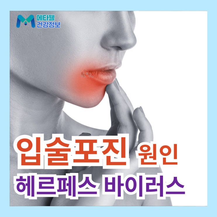 헤르페스는 무조건 성병일까? 입술포진 원인, 증상 및 치료법 오해와 진실