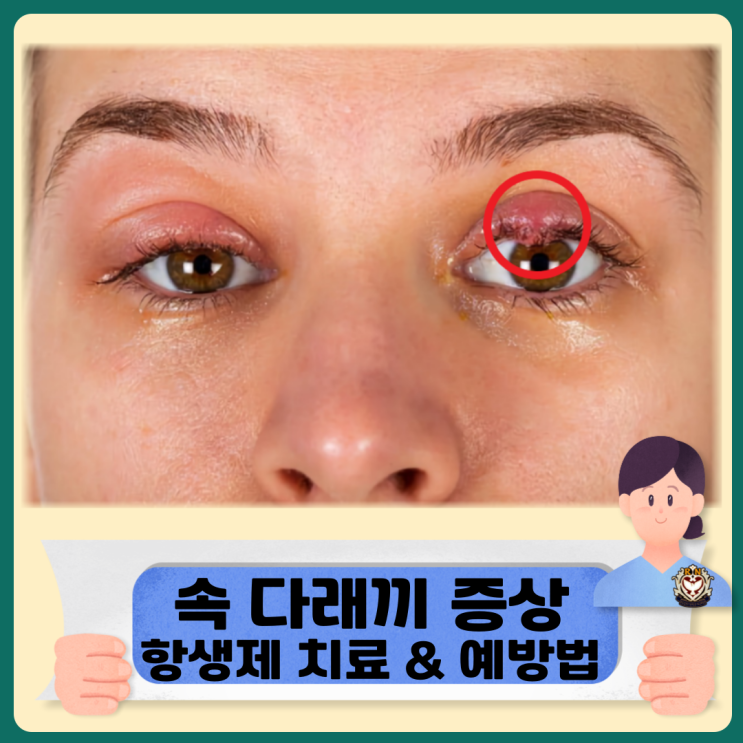  속 다래끼 증상 및 항생제 치료와 예방법