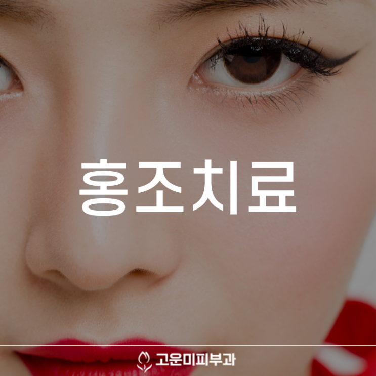  대구반월당홍조치료 얼굴이 화끈거리고 붉어지는 증상 치료 고운미 피부과