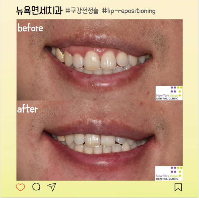  웃을 때 윗 입술 비대칭 해결 방법