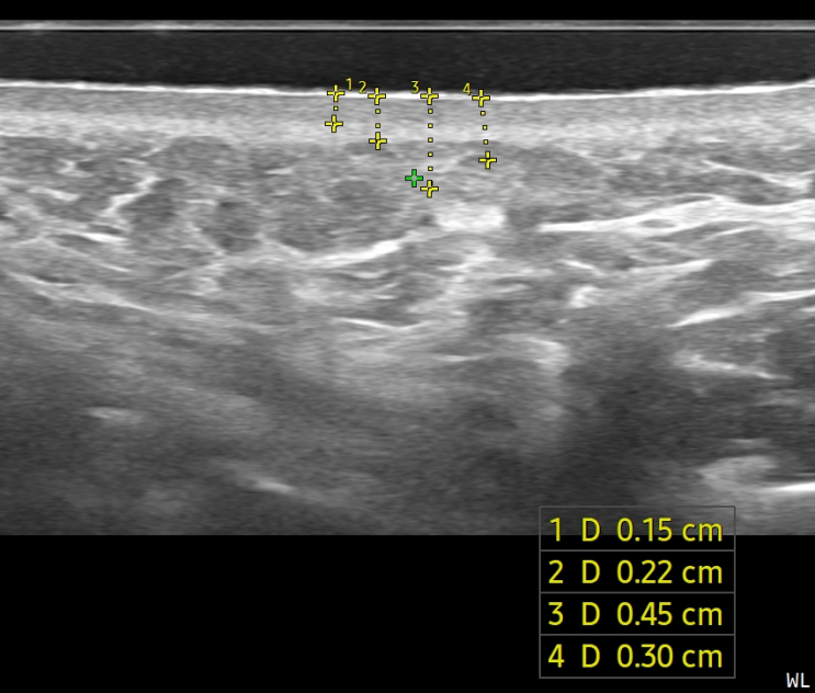  슈링크 vs 울쎄라 차이 비교. 효과, 부작용(화상, 수포), 가격. HIFU 시술. high intense focused ultrasound