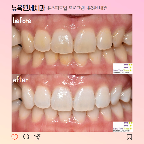  역삼역 치아미백 추천 밝고 환한 치아로