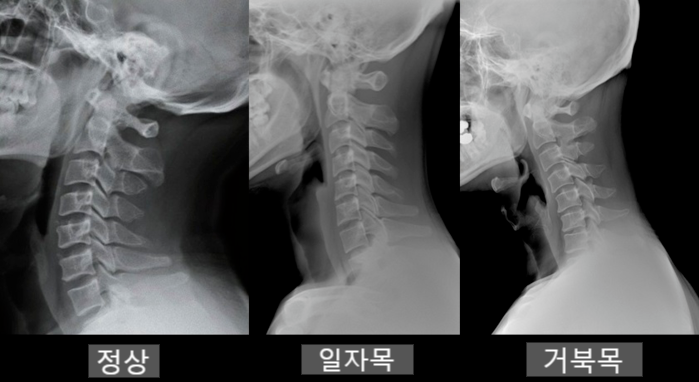 경추 후관절 증후군(Cervical facet joint syndrome)_【진료용】 : 네이버 블로그