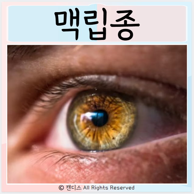  맥립종 원인 다래끼 전염 관리 치료는?