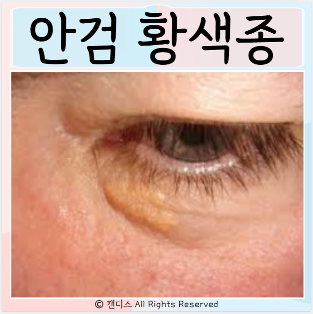 안검 황색종 증상 치료 원인