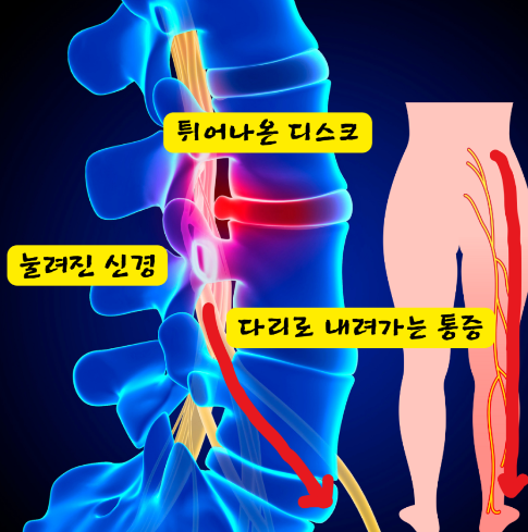  해운대허리디스크, 나는 왜 통증이 그대로일까?