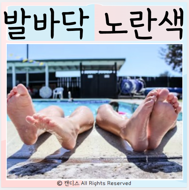  발바닥 노란색 원인 무좀 카로틴혈증 간질환 황달