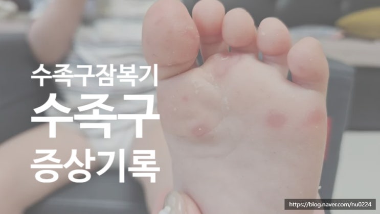  [두돌아기 수족구 증상기록] 수족구 잠복기 기간과 수족구증상