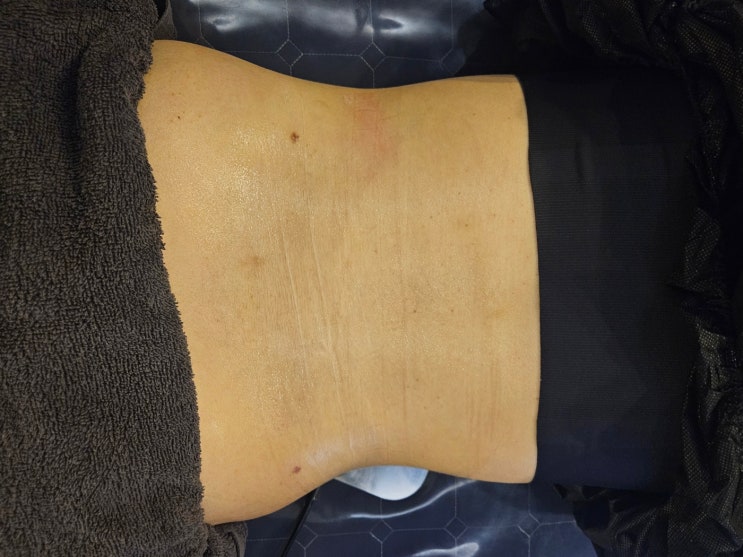  복부 지방흡입 후관리 사이즈 변화가 없는 이유 3 가지