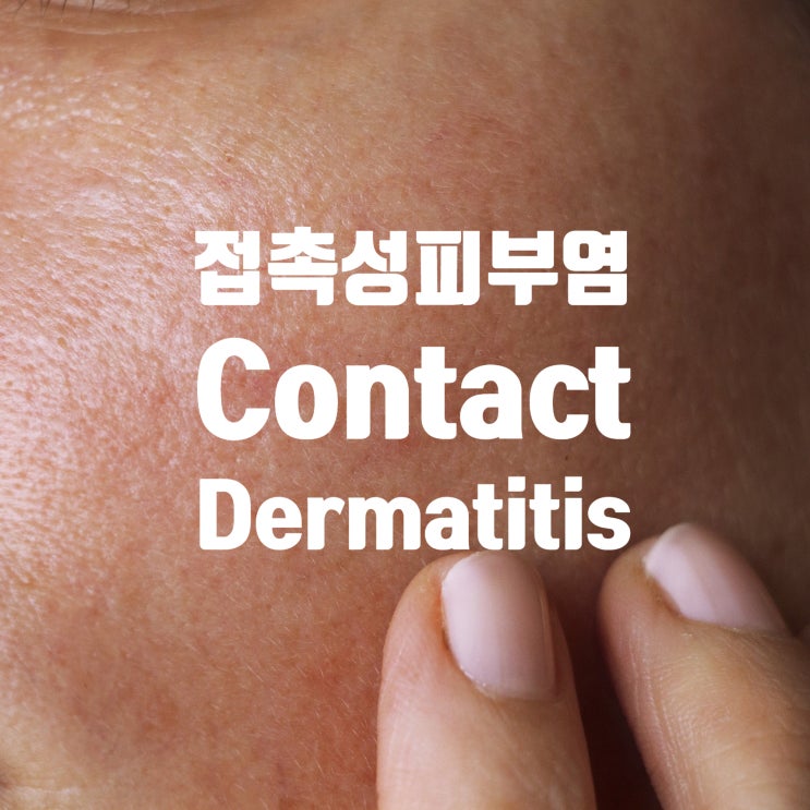  접촉성피부염이 반복되는 여러분에게,