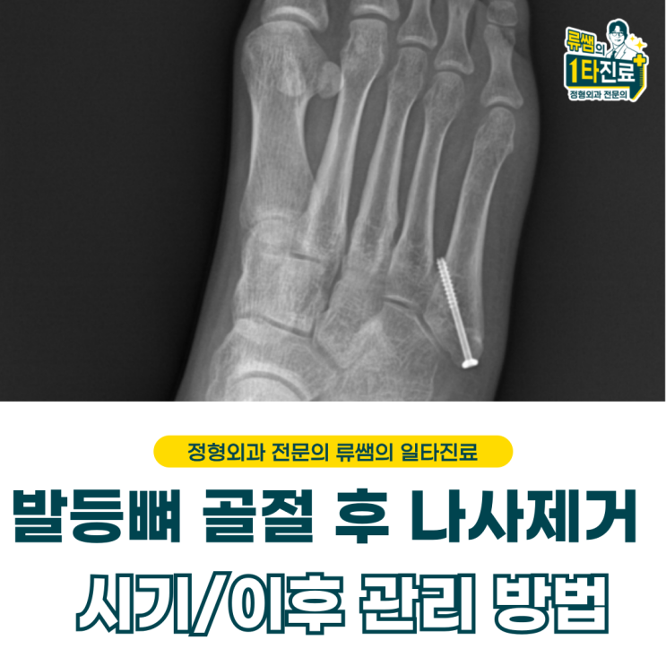  발등뼈 골절 후 나사 제거/ 시기, 관리 방법(의사작성)