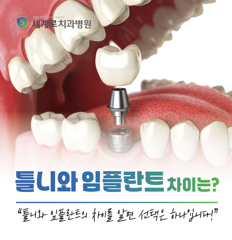  틀니 vs 전체임플란트 차이를 알면 선택은 하나