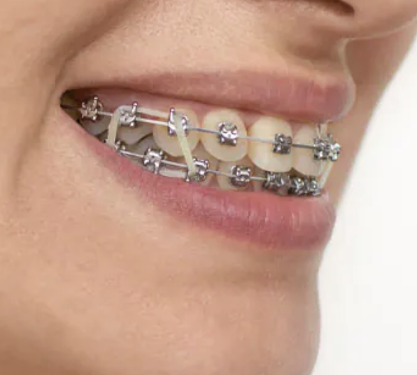  교정용 고무줄 특징 - 사이즈 - 크기 - 종류 - 치아교정 엘라스틱