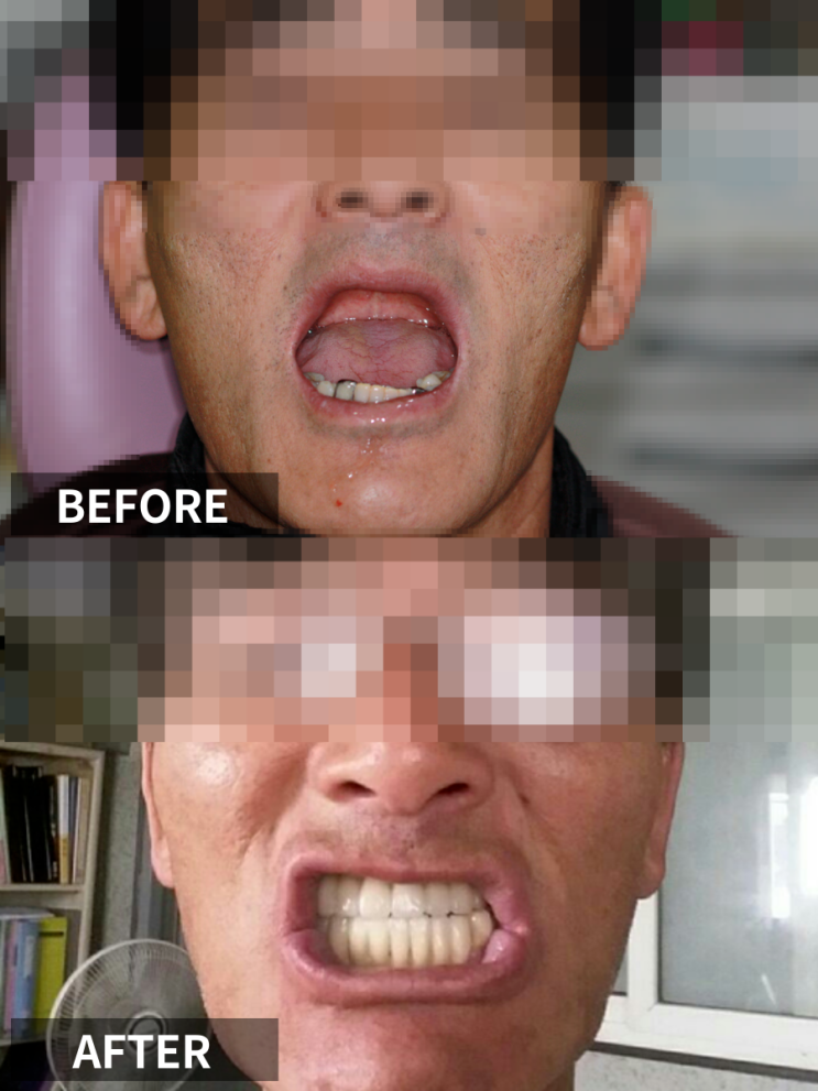  치위생사 딸의 추천으로 전체임플란트 13개 식립한 후기,가격