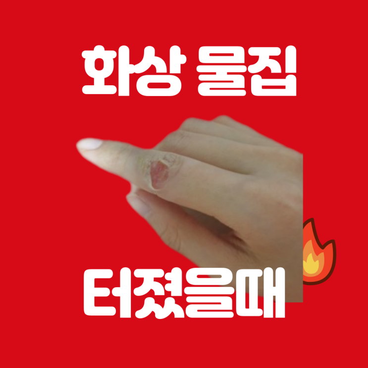  화상 물집 터졌을때 밴드 연고 메디폼 치료 방법
