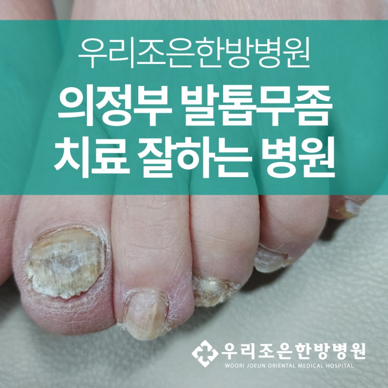 의정부 우리조은한방병원 발톱무좀 치료 방법
