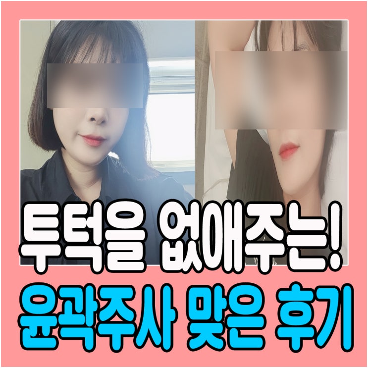  대전 윤곽주사 투턱에서 브이라인 만들어준 후기