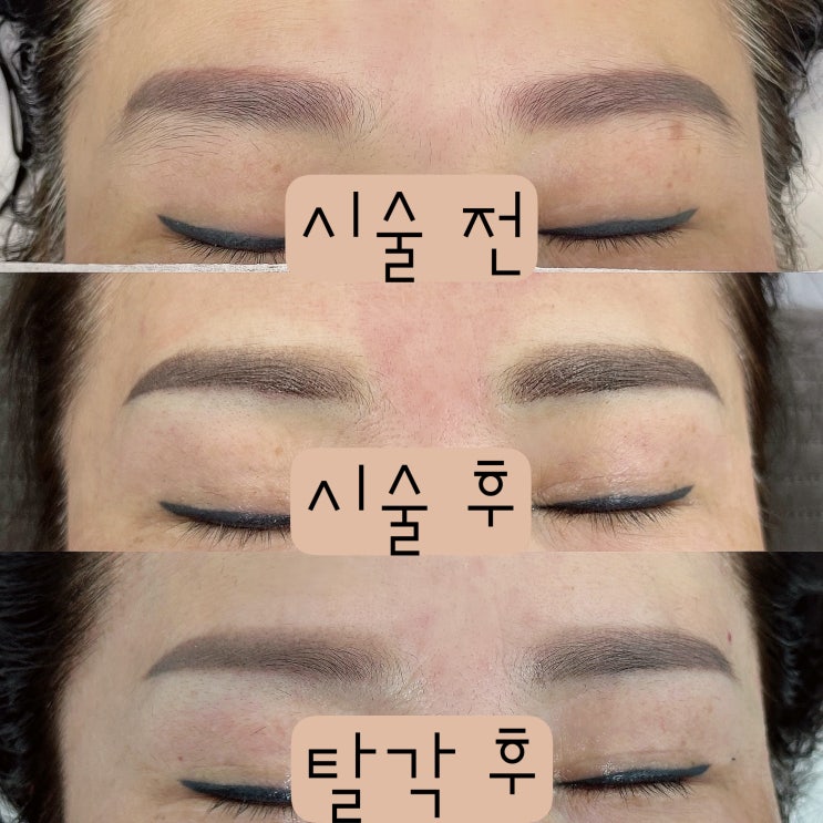 천안 눈썹잔흔커버, 붉은잔흔 교정은 여기서! 천안 눈썹잔흔커버, 붉은잔흔 교정은 여기서!