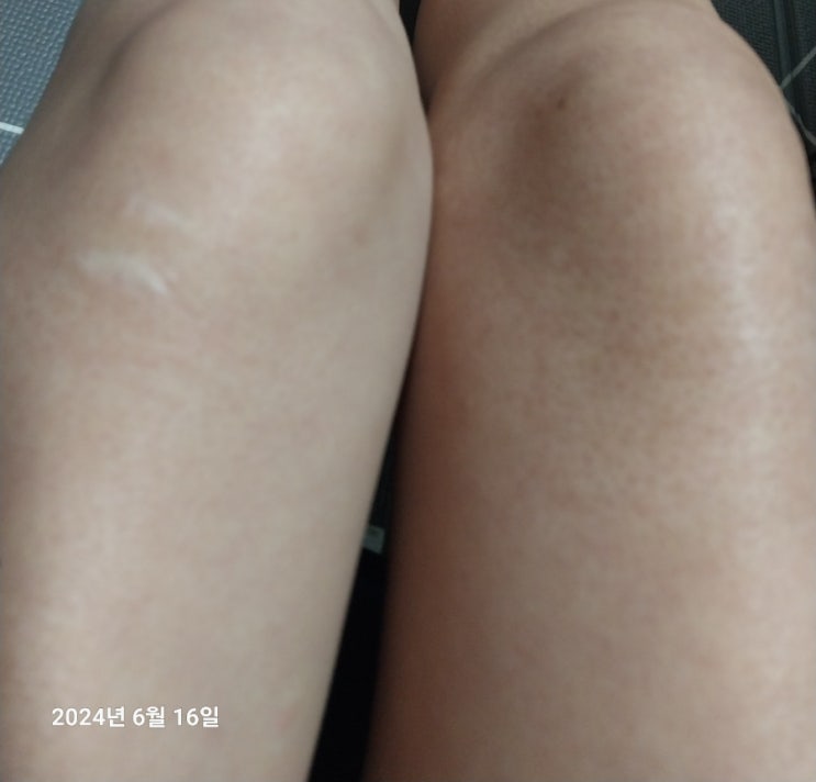  수십년 지난 무릎 화상흉터 화상자국ㅣ간장 소주 민간요법 화상치료