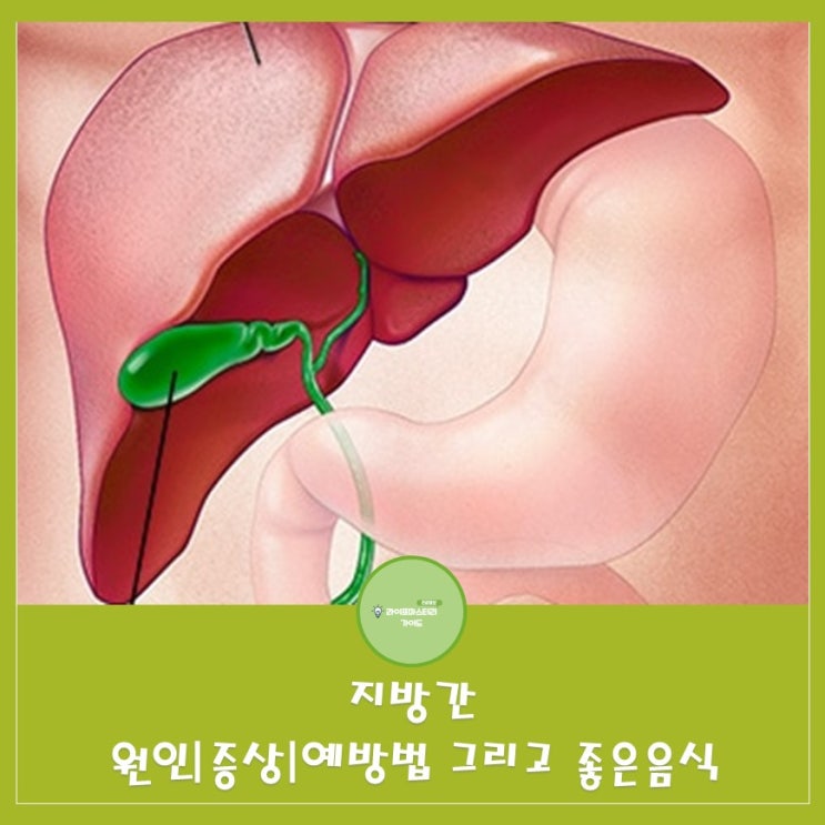  지방간의 원인과 증상 예방법 |지방간에 좋은 음식