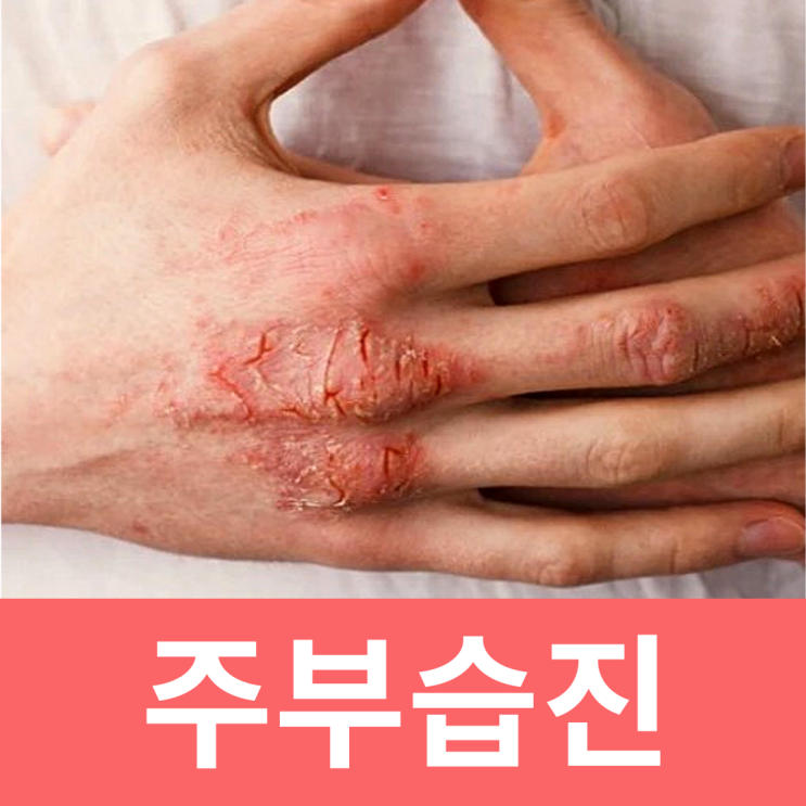  손등 주부습진 손바닥 손가락 주부습진 연고 증상