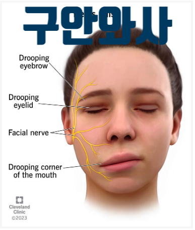  구안와사 전조증상 대처와 치료(구와나사 X, 구안괘사 O)
