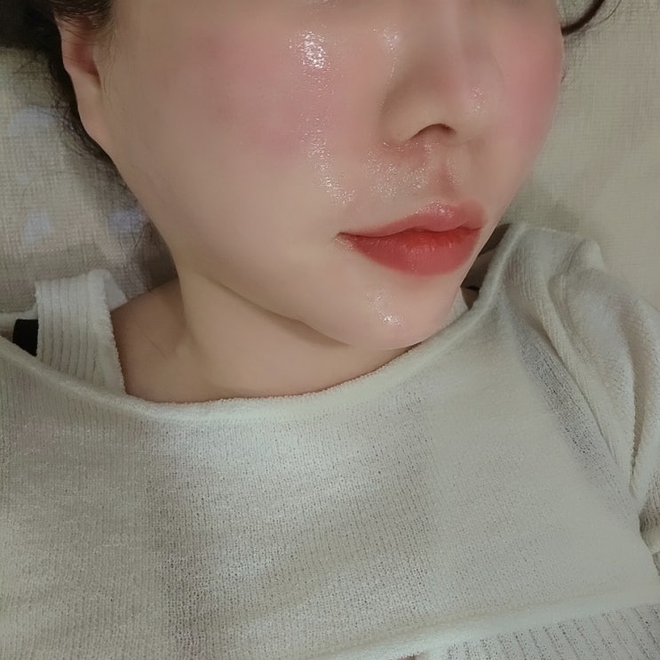  압구정피부과 라라필 엑소좀 도자기실펌 한번에 받은 후기